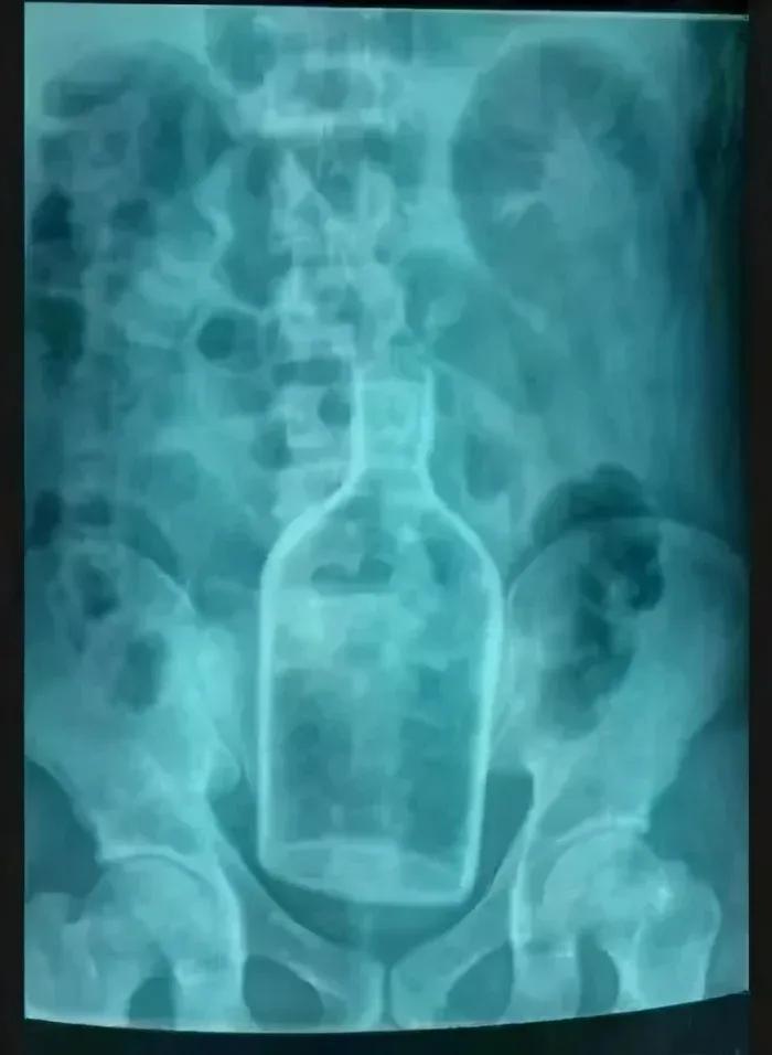 菊花塞足球，人体的极限到底有多大？