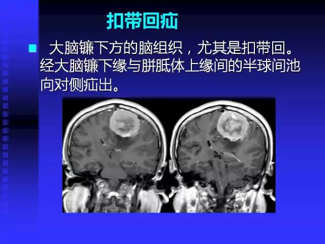 头颅mri读片视频教程,颅脑mri读片入门教程视频讲解全集