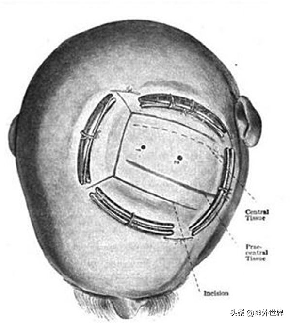 神经外科的止血方法,神经外科医学常识总结