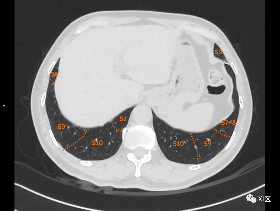 如此详细的肺部影像解剖，有点儿酷