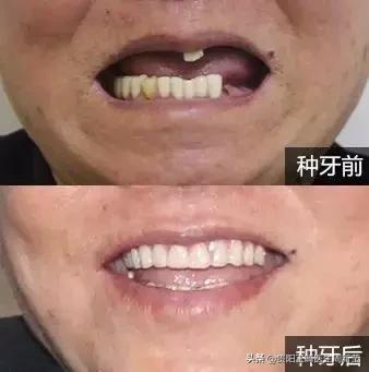 烤瓷牙做过后最好的修复方法,烤瓷牙里面的真牙烂了怎么办