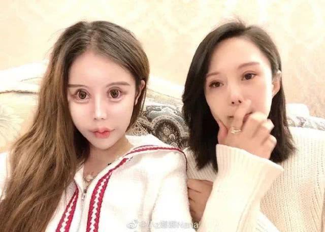 做6次双眼皮4次鼻子，下巴似铁锥眼睛整成球，16岁就整成这样好吗