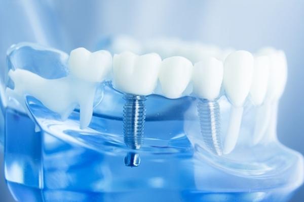 一个月工资种牙,一年工资不够种牙