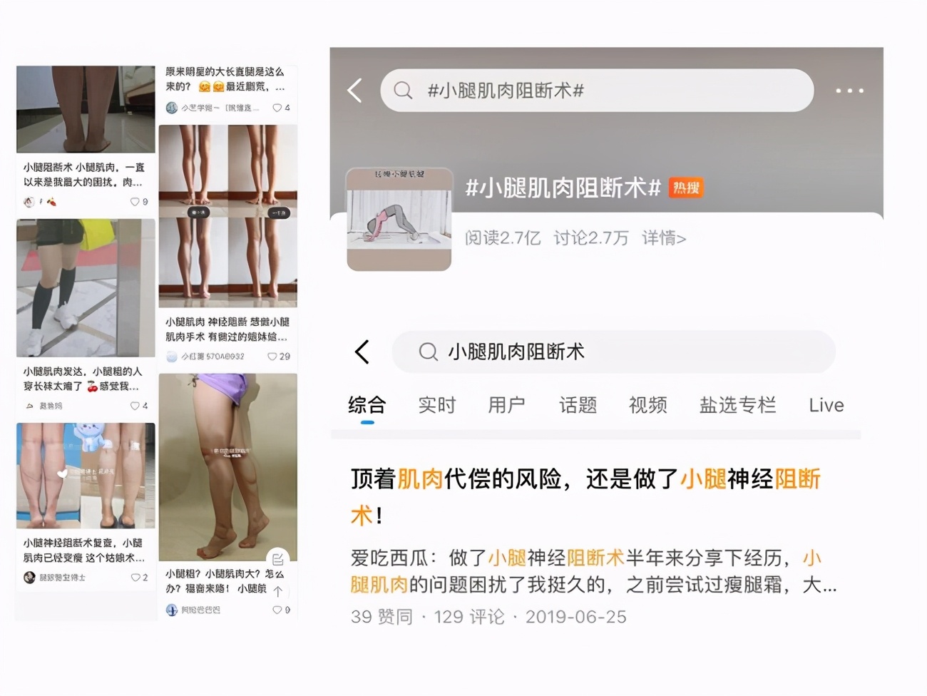 小腿肌肉阻断术新闻,小腿肌肉阻断术相关时评