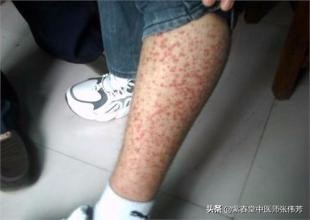 过敏性紫癜留下的色素沉着怎么治,过敏性紫癜出血点都在什么位置