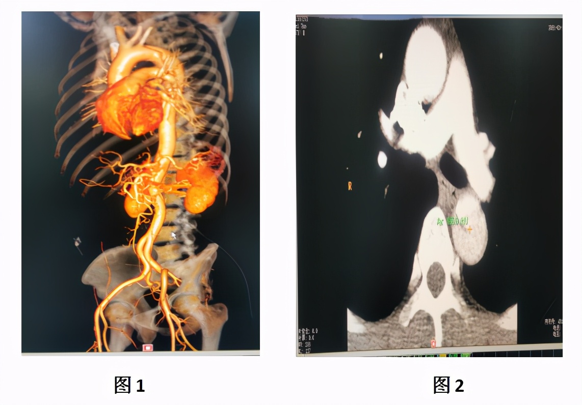 高血压引起的动脉夹层破裂死亡,高血压引起的主动脉夹层抢救