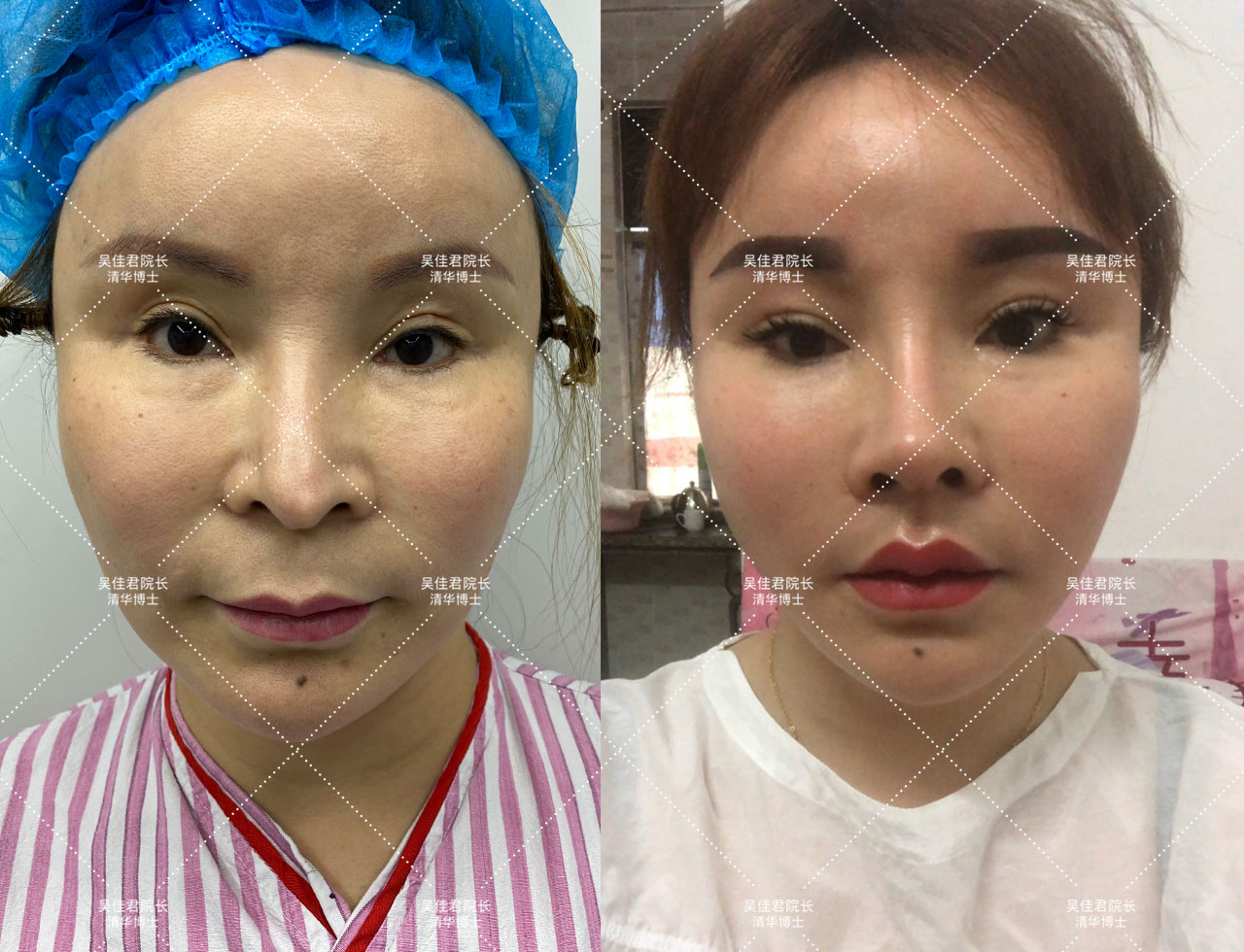 做小拉皮术后怎么保养,做拉皮手术的亲身经历注意事项