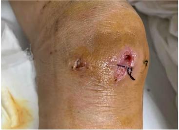 60岁阿姨被缝线针戳破膝盖，引发感染，住院治疗1个月