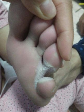 治疗脚气偏方韭菜根,辟谣脚气偏方不可信