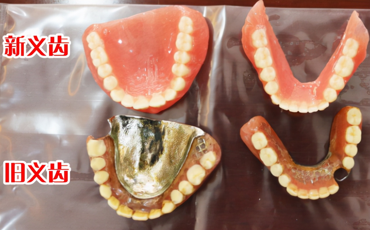 70岁老人种牙好还是义齿好,义齿和种植牙的区别老年人