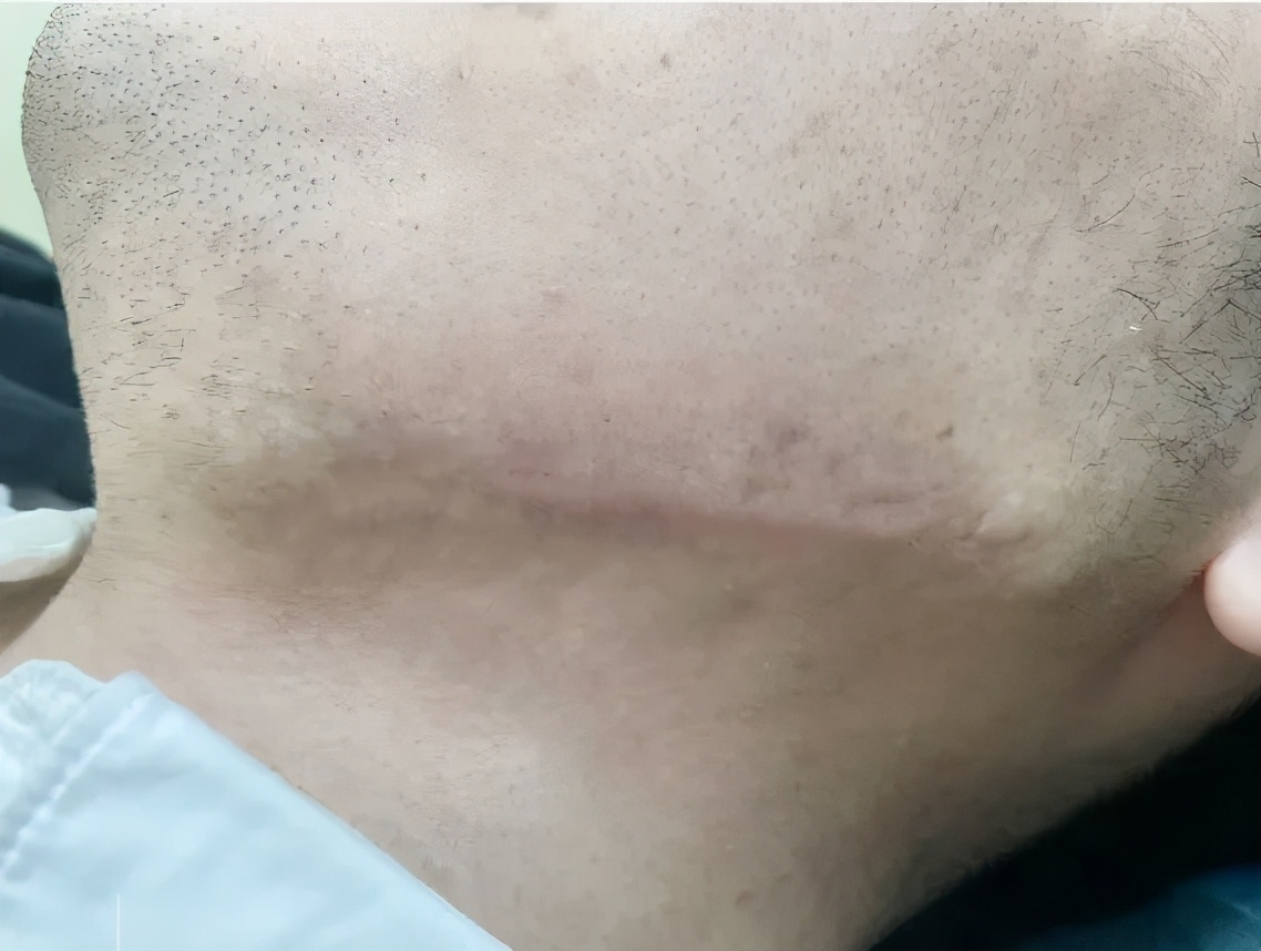 下颌缘痘痘反复,下颌痘痘反反复复怎么办