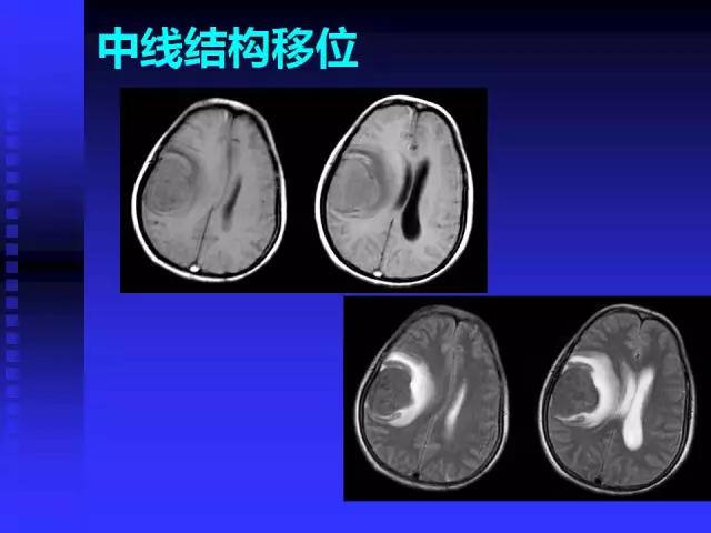 头颅mri读片视频教程,颅脑mri读片入门教程视频讲解全集