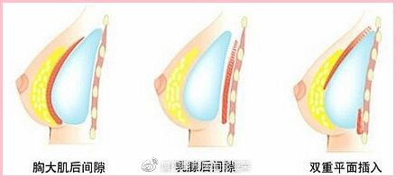 假体隆胸和自体隆胸的各自优势,假体隆胸和脂肪隆胸怎么选