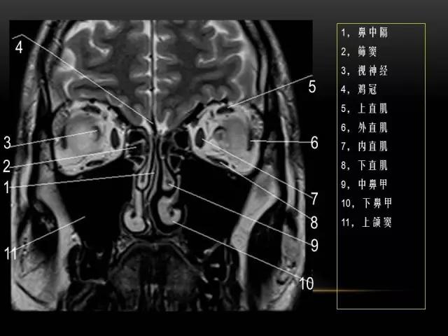 鼻腔鼻窦及颅底ct影像解剖,鼻窦解剖mri