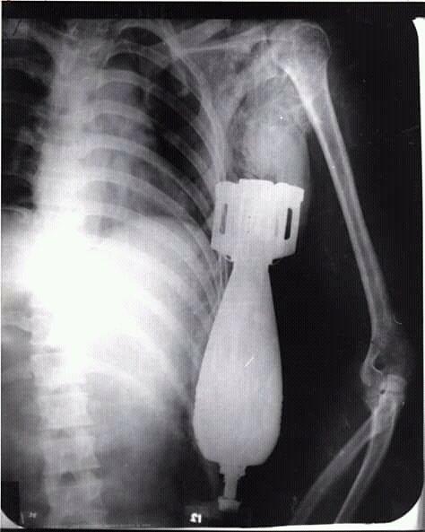 迫击炮真实战争,迫击炮rpg