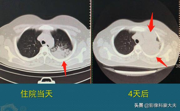1场支原体肺炎，我拉黑了学理科的女同学