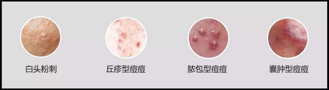 看懂各种痘痘类型和应对方法,一分钟教你分辨痘痘类型