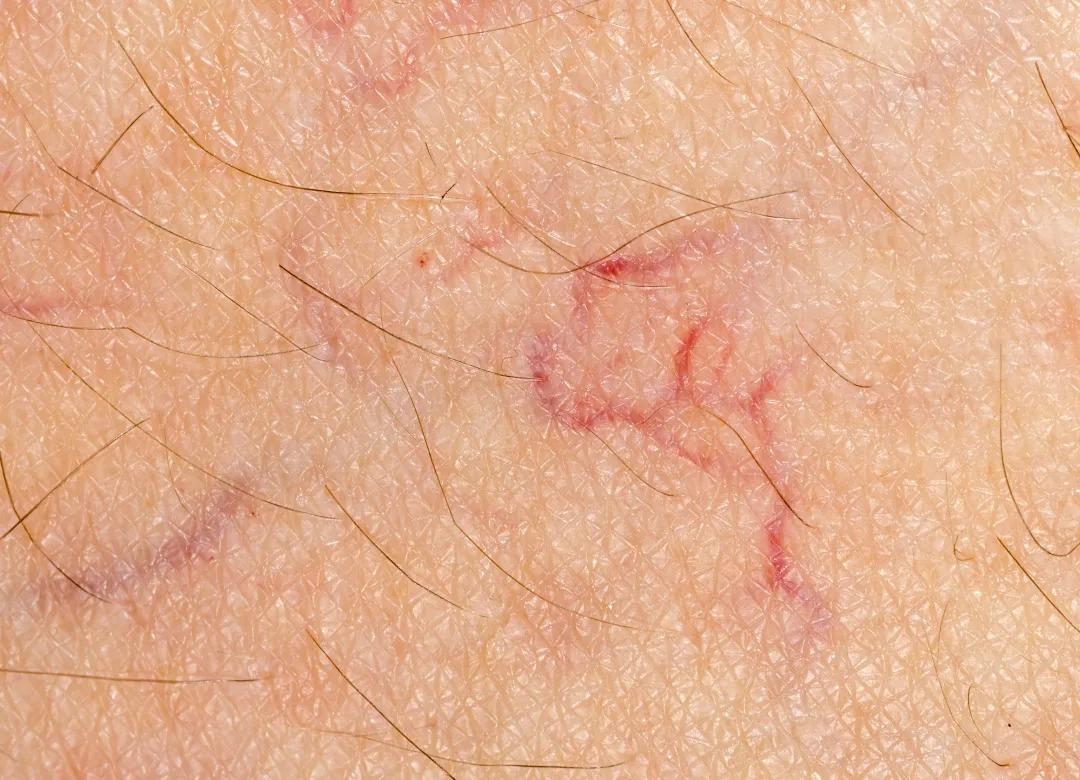 身上突然起小红点需要看医生吗,身上长了密密麻麻的小红点是什么