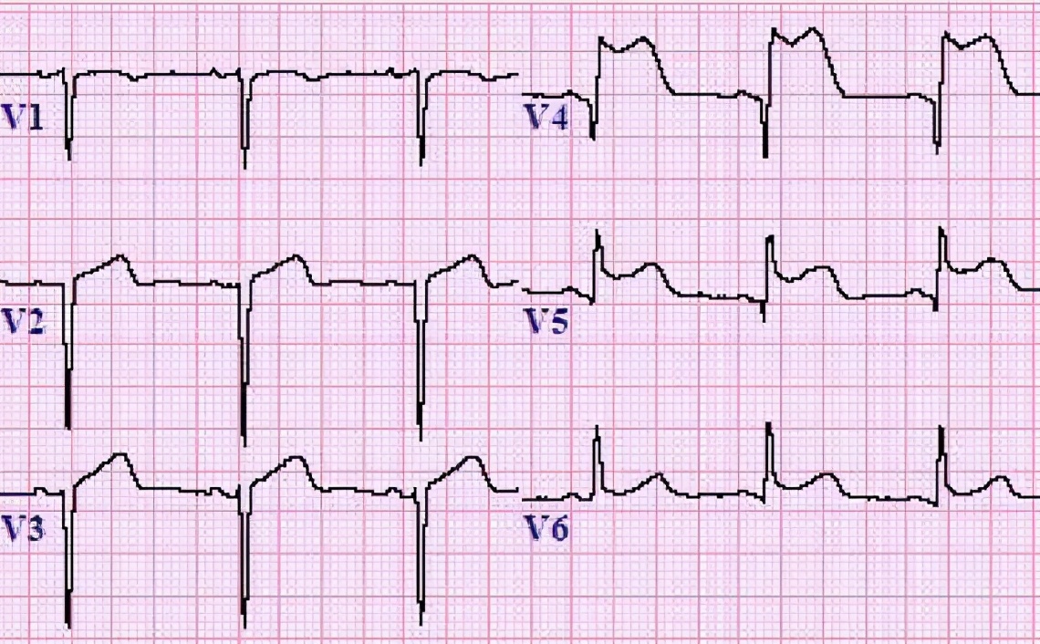 心脏彩超和动态心电图哪个准确,心电图跟心脏彩超哪个更准确