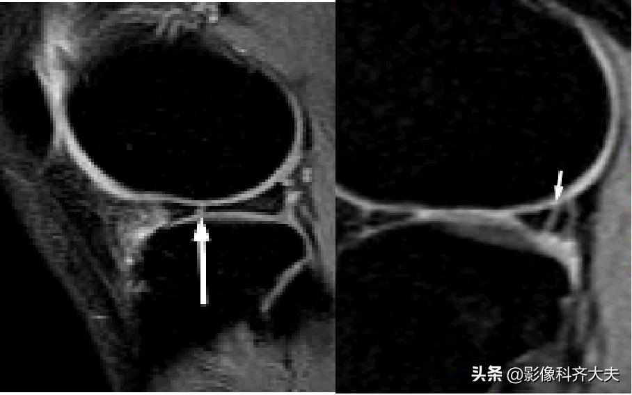 膝关节半月板损伤的磁共振,膝关节半月板病变的mri诊断与鉴别
