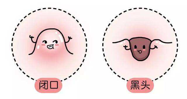 痘博士怎么治疗毛孔粗大的,痘博士的最佳治疗方法