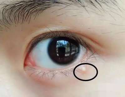 鐚剛鑲矑鎬庝箞娑堥櫎,娑堥櫎鑴傝偑绮掔殑濡欐嫑