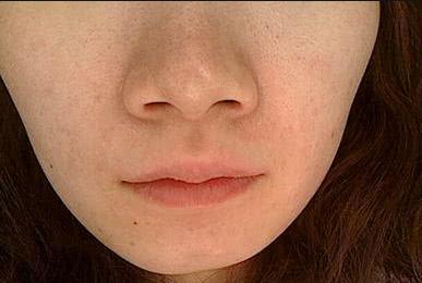 毛孔粗大怎么办教你一招收缩毛孔,毛孔粗大怎么办什么方法有效