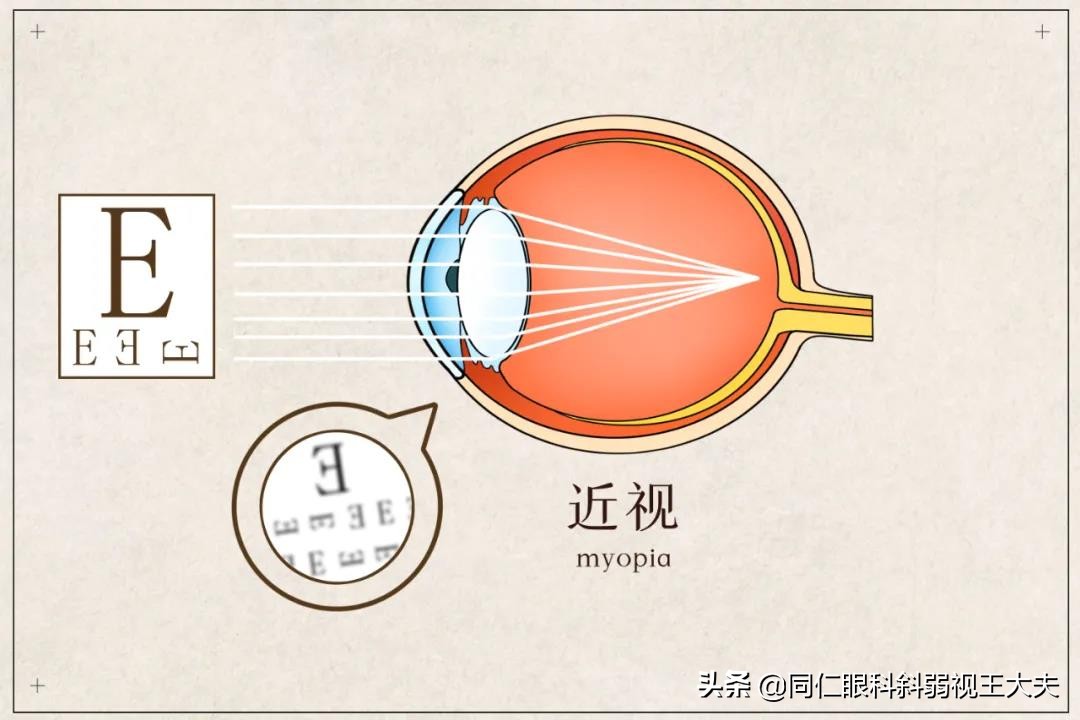近视600度但是看东西很清楚是为啥,近视600度不能看见2.0吗