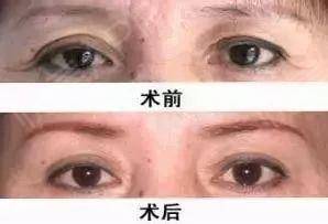 面部衰老改善最好的方法,衰老与面部轮廓的变化