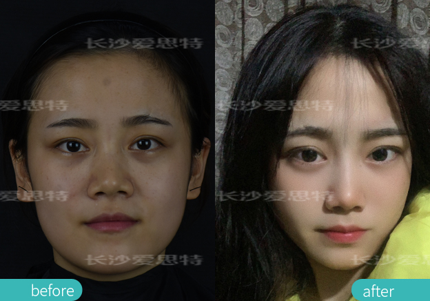 祛雀斑用皮秒好还是光子嫩肤好,祛斑用激光好还是光子嫩肤好一点