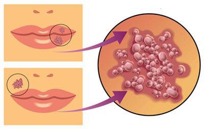 上火了嘴边起泡要弄破吗,上火嘴起泡是病毒感染吗