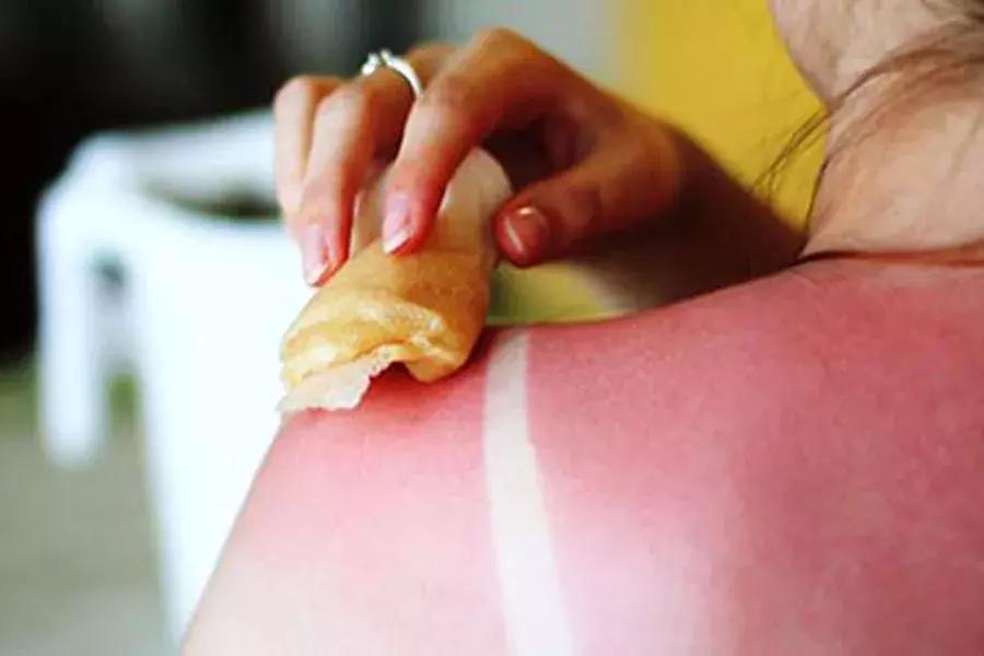 旅游归来身上却突发奇痒，日光性皮炎该如何应对？