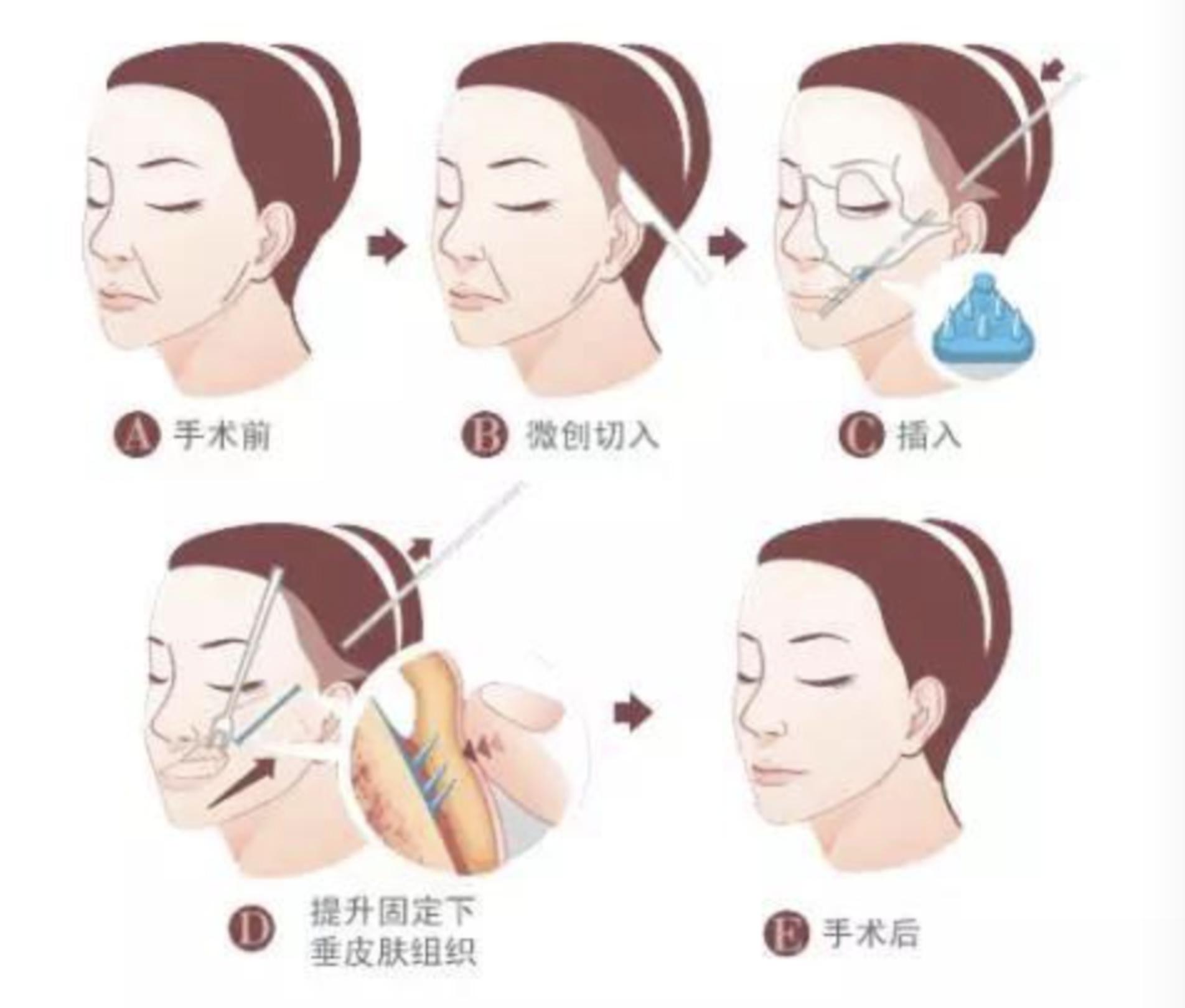 面部线雕的最终效果,面部线雕提升案例后的变化