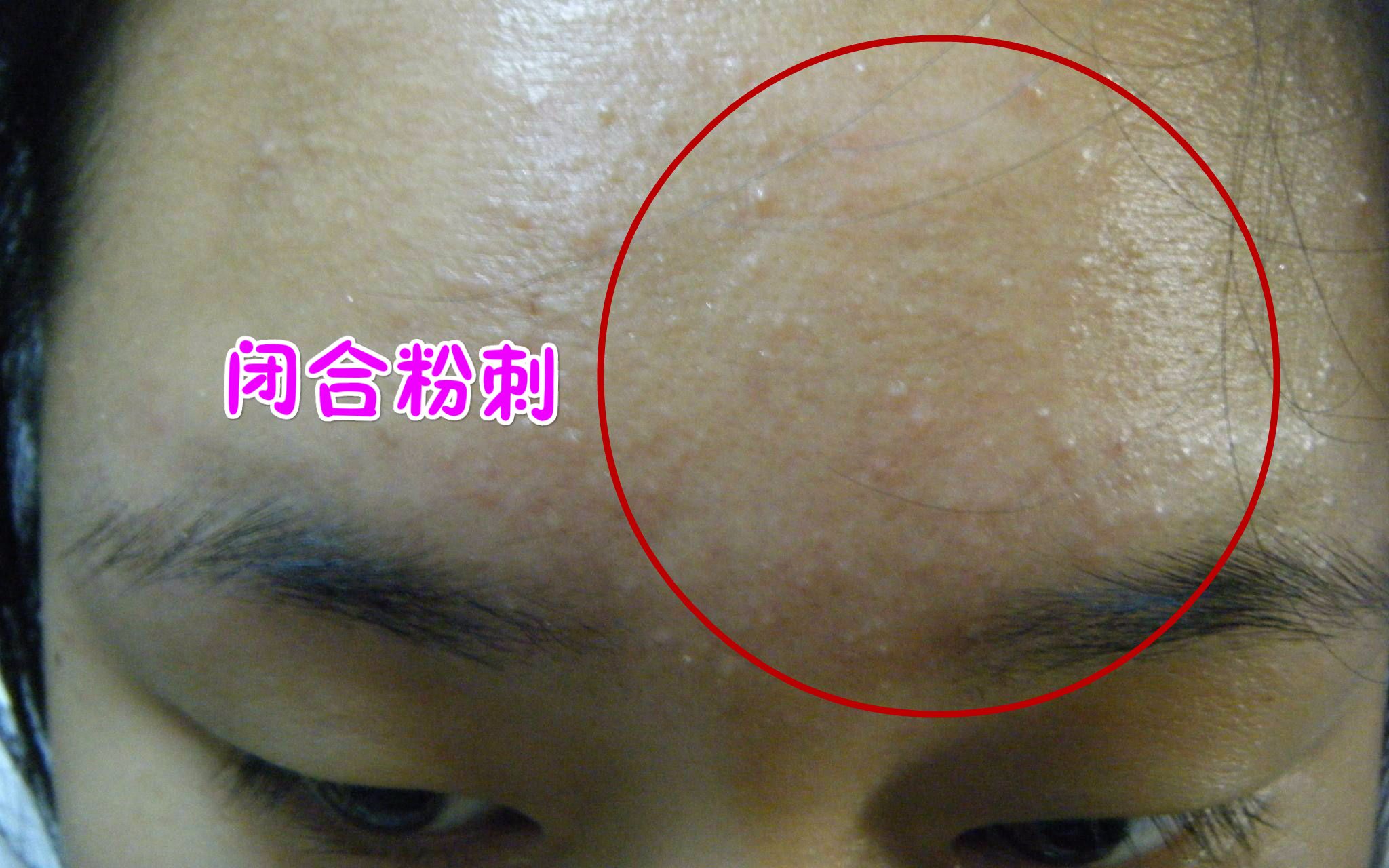 去黑头白头的最有效的方法,如何去除黑头白头学生党