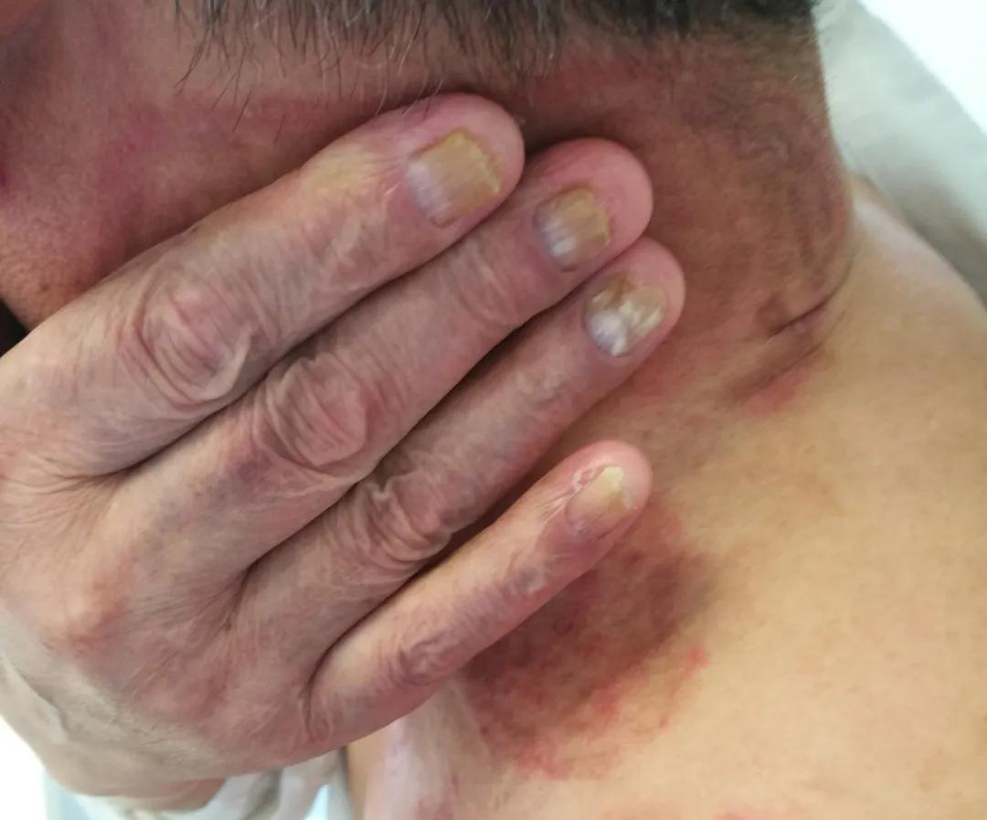 汗斑、花斑癣和花斑糠疹