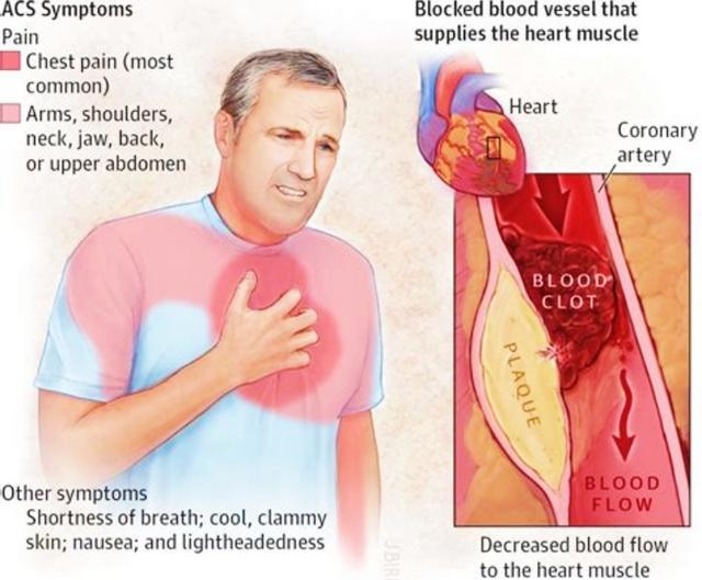 肩膀疼痛竟是如此大问题不可小觑,肩膀疼痛的辨别和解决方法