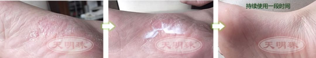 冬季皲裂膏预防脚后跟干裂好用的,上热门脚后跟干裂保湿霜