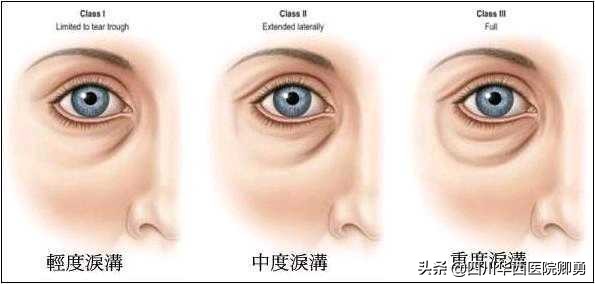 眼袋泪沟卧蚕怎么消除掉,眼袋和卧蚕泪沟怎么消除