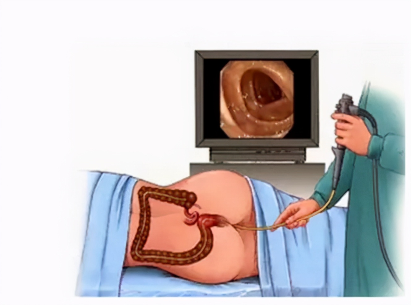 肠镜肠道准备必须喝3升泻药吗,无痛肠镜肠道准备差会影响结果吗