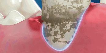 刷牙黄牙变成白牙怎么办,怎么刷牙才会让黄牙变成白牙