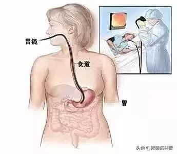 科普胶囊内镜和电子内镜该怎么选,胶囊内镜与无痛胃肠镜区别
