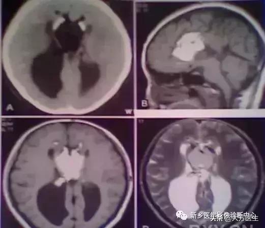钙化灶是良性肿瘤的可能性大吗,颅内肿瘤钙化发生率最高