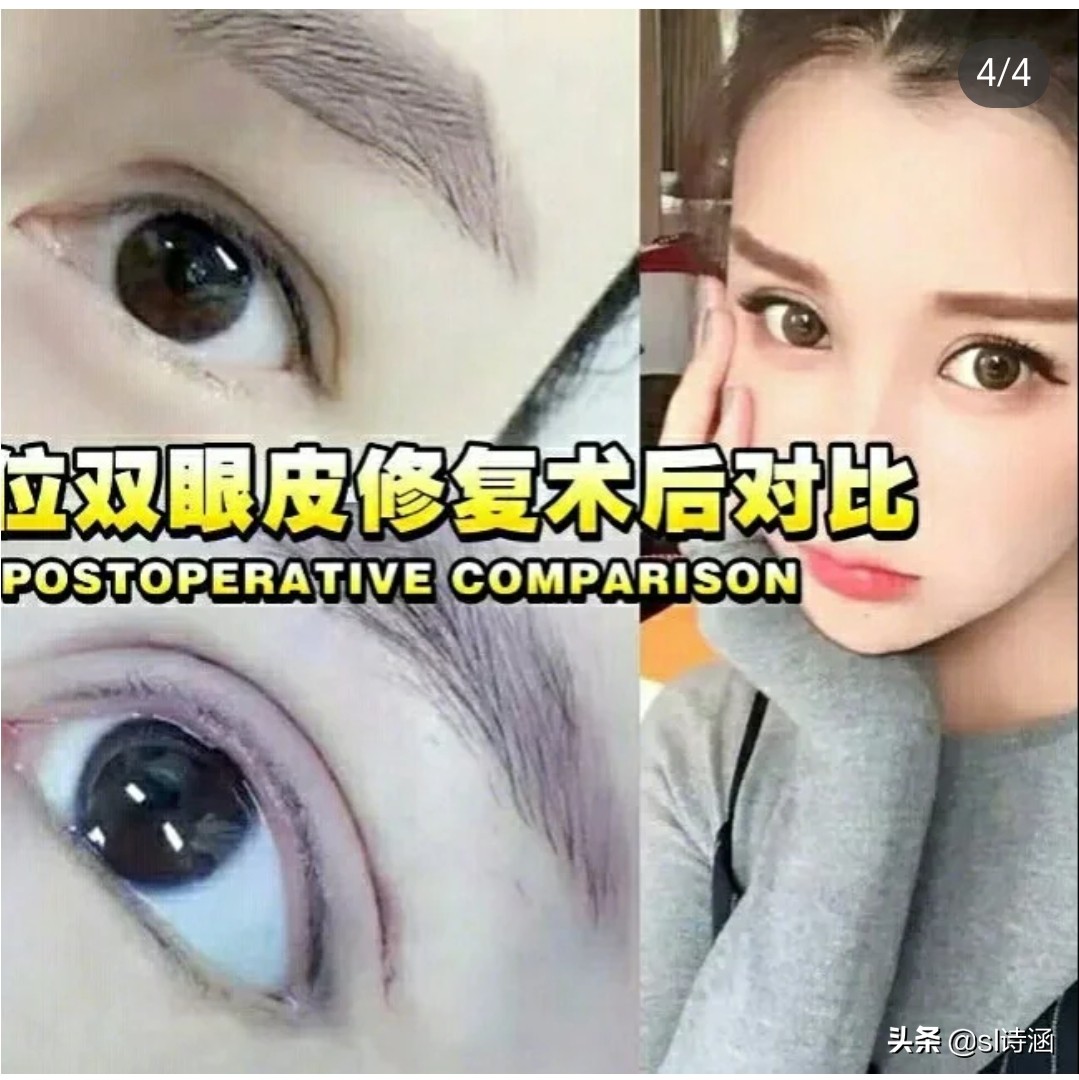 做完双眼皮之后有什么注意事项,做完双眼皮过后应该注意些什么