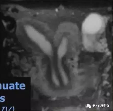 子宫发育异常，应想到的6大类常见畸形