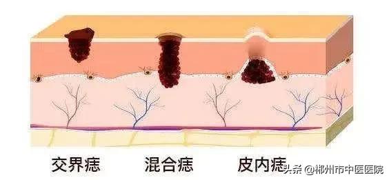 皮下出现黑点是色素痣吗,慢慢长很多色素痣是为什么