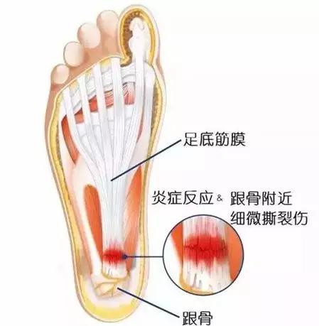 脚跟痛不要再让骨刺背黑锅了,足跟骨刺痛一招教你解决