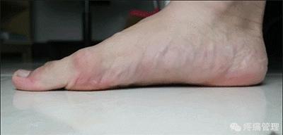 专门改善扁平足的运动,站着改善x型腿