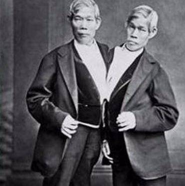 中国连体双胞胎兄弟,连体兄弟中国