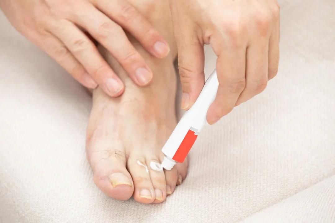 根治脚气的小窍门是什么,脚气反复用什么药治疗
