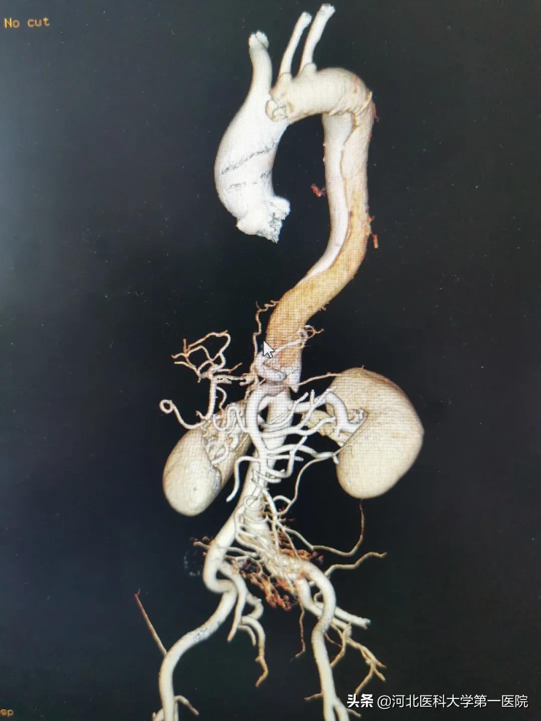 血管内再造血管？刀锋拆弹三开窗这种死亡率48小时达50%的疾病